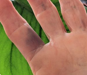 bruised and broken blod vessels fingers from gardening